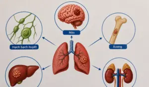Ung thư phổi có thể di căn đến những cơ quan nào? Tìm hiểu các vị trí di căn thường gặp và dấu hiệu cần lưu ý.