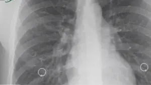 Người đàn ông phải tái tạo đường thở vì ung thư sau hơn 30 năm nghiện thuốc lào. Câu chuyện là lời cảnh báo về tác hại của thuốc lào.