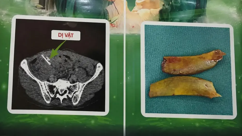 Người đàn ông hai lần thủng ruột vì nuốt xương. Hình ảnh CT và dị vật sau phẫu thuật là lời cảnh báo về thói quen nguy hiểm.