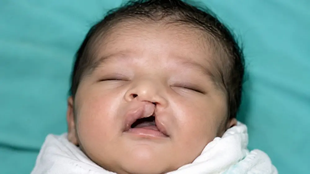 Bác sĩ Hàn Quốc phối hợp Bệnh viện Nhi Thanh Hóa phẫu thuật miễn phí cho trẻ mắc dị tật khe hở môi, vòm miệng.