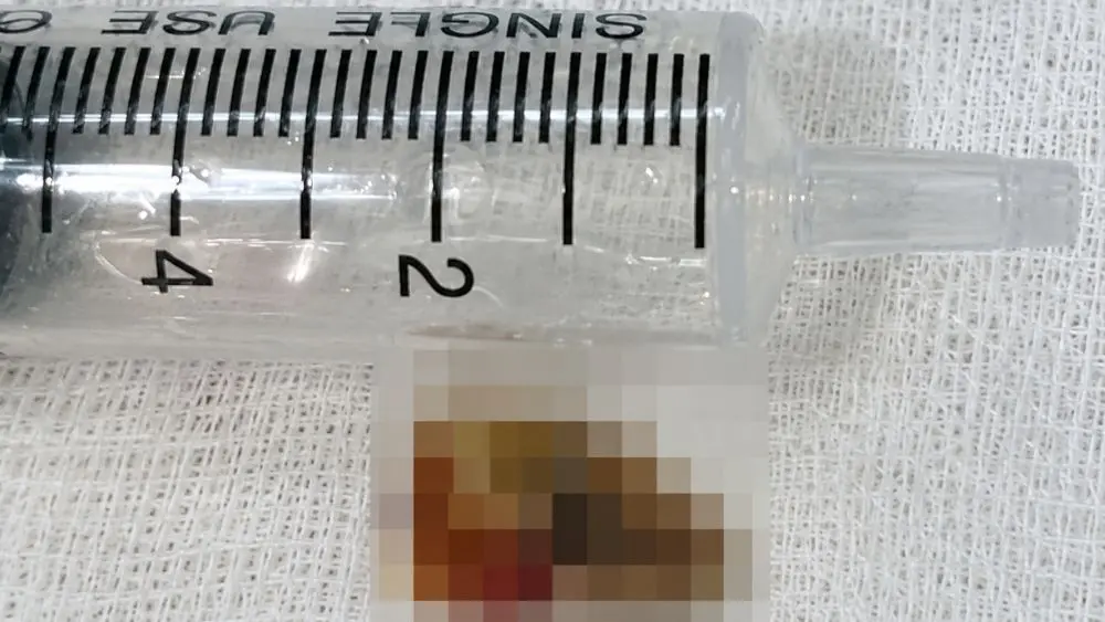Gắp mảnh xương ống nằm sâu trong phế quản người phụ nữ 68 tuổi ở Nghệ An sau thời gian dài gây tắc phế quản, nhiều ổ mủ.